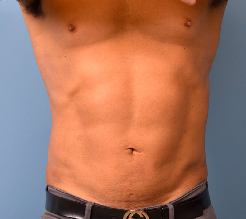 What Can Help With Swelling After Tummy Tuck Surgery?