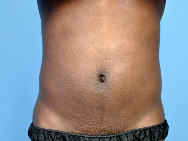 What Can Help With Swelling After Tummy Tuck Surgery?
