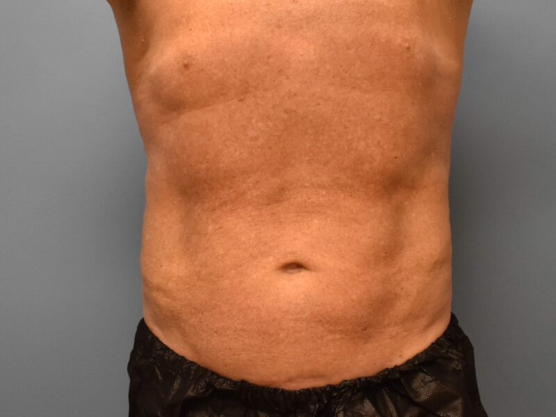 What Can Help With Swelling After Tummy Tuck Surgery?